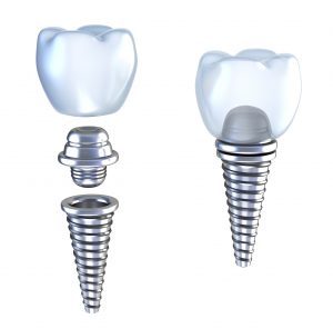 Mit Sicherheit zum Zahnimplantat: Dank 3D-Planung | Zahnarzt Lauf