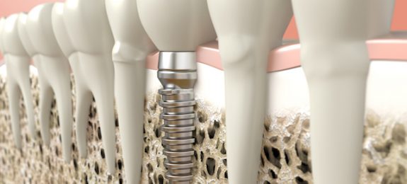 Zahnimplantate: Eigenblutplasma (PRGF) für eine sichere Verankerung im Kieferknochen | Zahnarzt Lauf