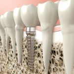 Stabiles Fundament für Zahnimplantate: Knochenaufbau mit dem Sinuslift | Zahnarzt Lauf